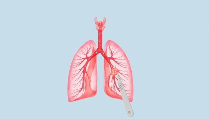 2023年世界慢性阻塞性肺病日是几月几日 2023世界慢阻肺日是哪天