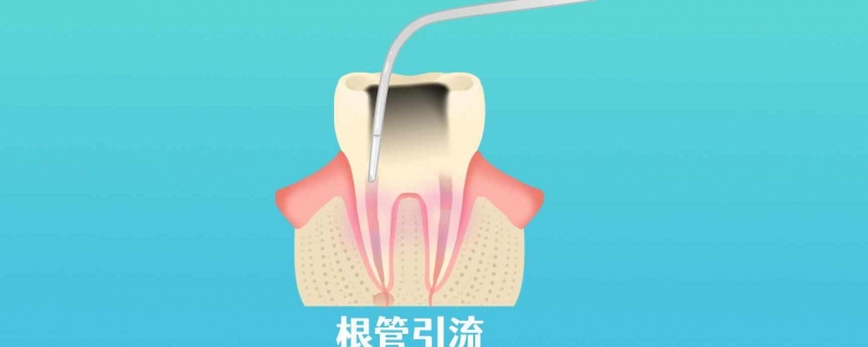 根管治疗疼吗