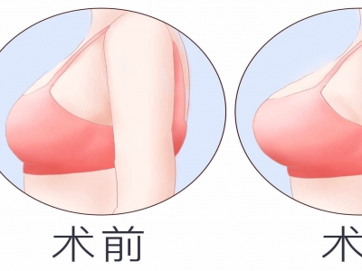 乳腺增生可以隆胸嗎 隆胸注意事項(xiàng)