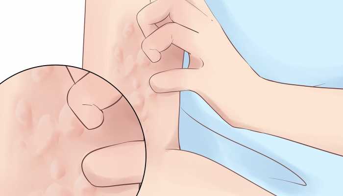 湿疹是由什么引起的 湿疹的原因是什么