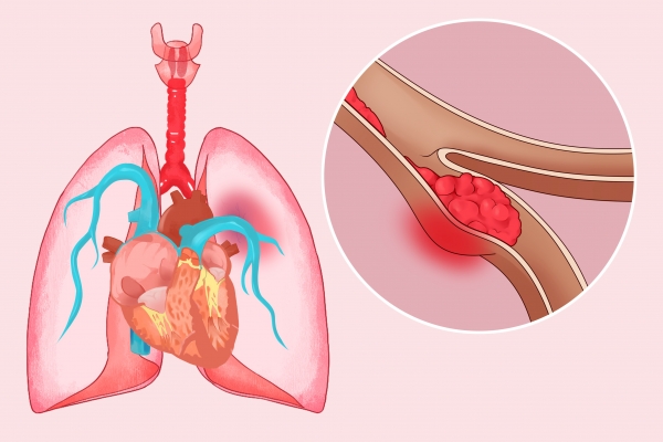 肺栓塞常見的原因有哪些