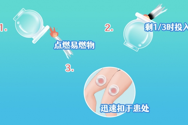 中暑可以拔罐嗎