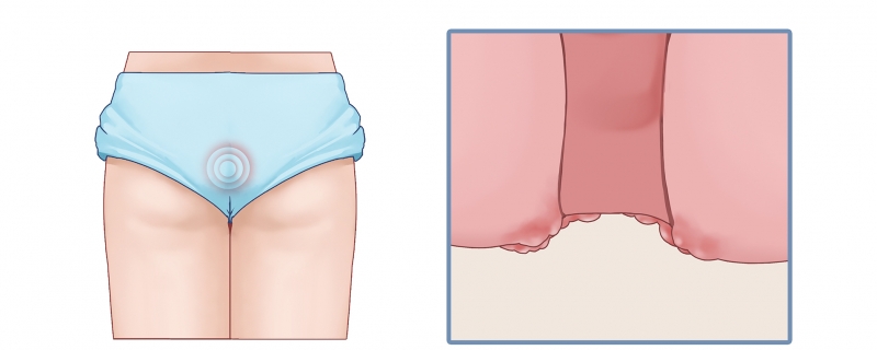 屁股肛門疼痛走路都疼怎么回事，怎么辦