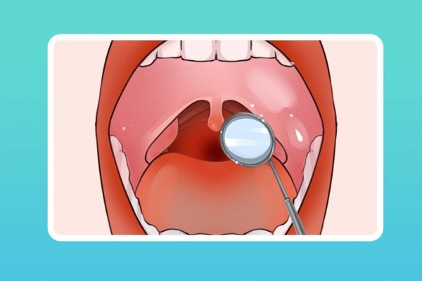 扁桃體化膿吃什么藥
