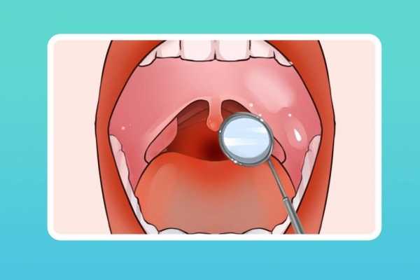 喉炎症状表现和治疗方法