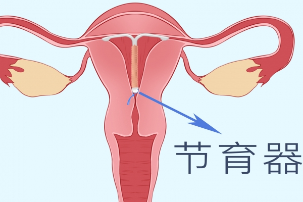 女人节育环有几种