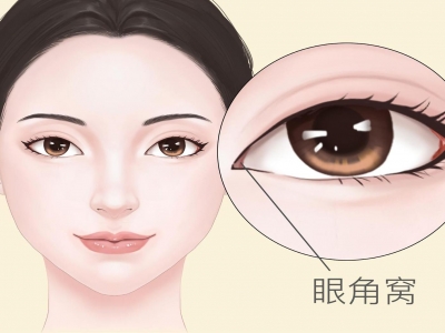 開眼角多久可以敷面膜 開眼角手術后護理方法