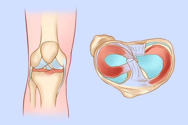 哈爾濱治療膝關(guān)節(jié)韌帶斷裂最好的醫(yī)院排名