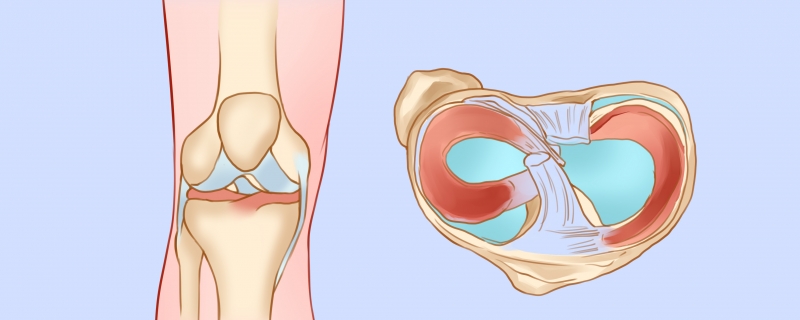 膝關(guān)節(jié)類(lèi)風(fēng)濕性關(guān)節(jié)炎怎么辦