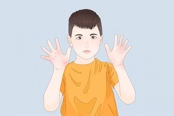 濕疹快速止癢的方法