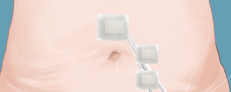 縫合的傷疤怎么去除
