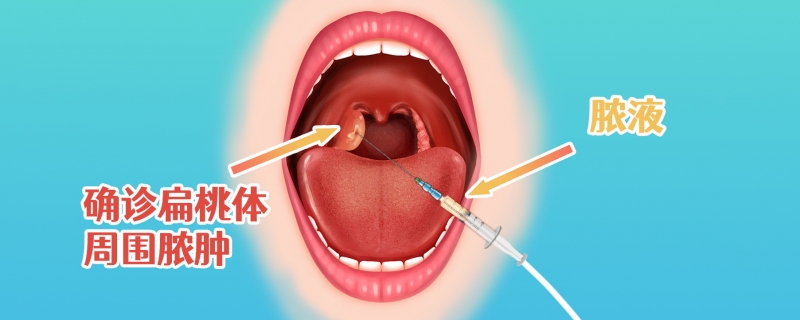 扁桃體1度腫大需要手術(shù)切除嗎}