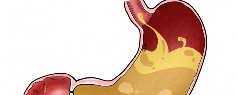 胃食管反流病能治好嗎