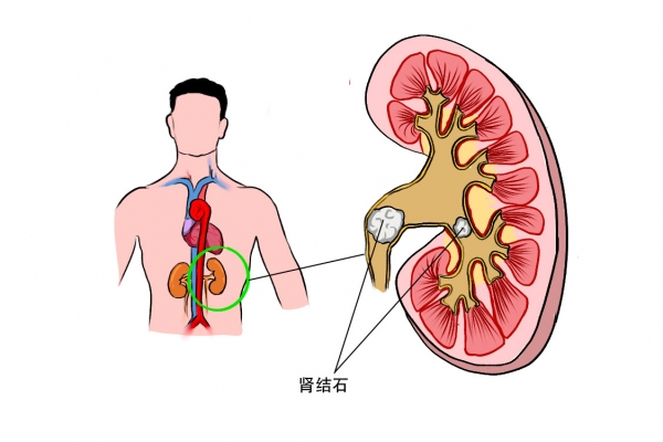 肾结石能不能吃猪耳朵