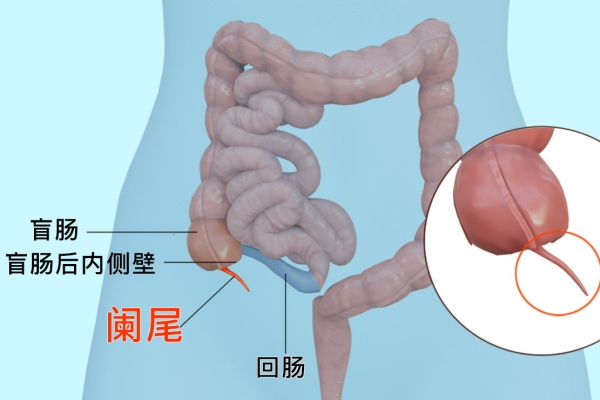 阑尾的位置