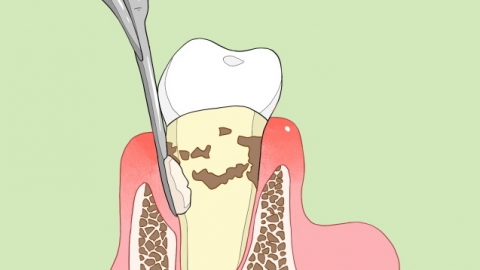 牙結(jié)石怎么清除