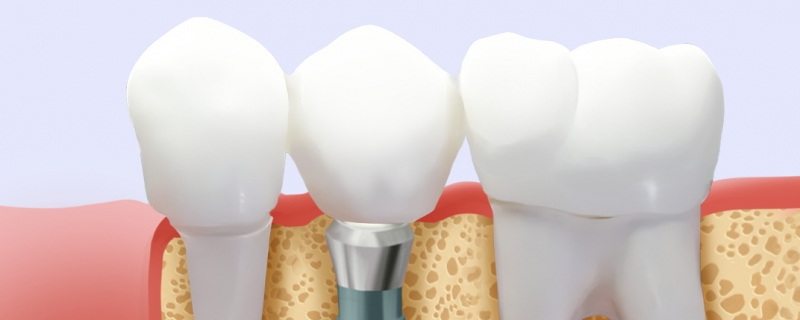 牙齒種植有副作用嗎}