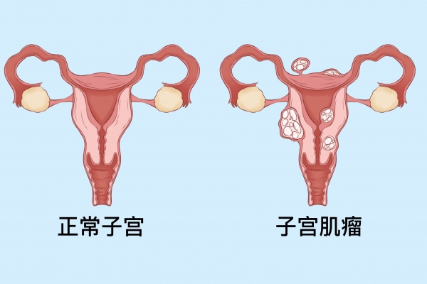 子宫肌瘤可以吃桂圆吗