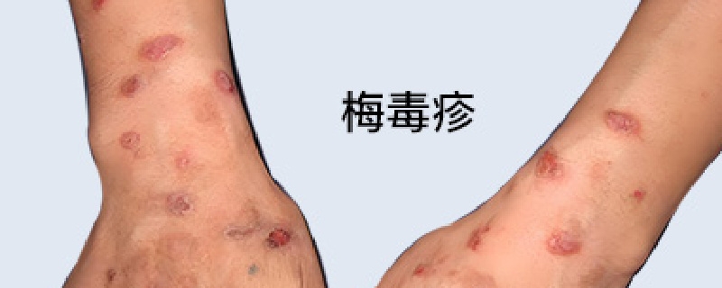 梅毒疹是平的還是凸起的}