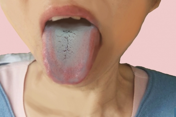 湿气重舌头的症状是怎样的