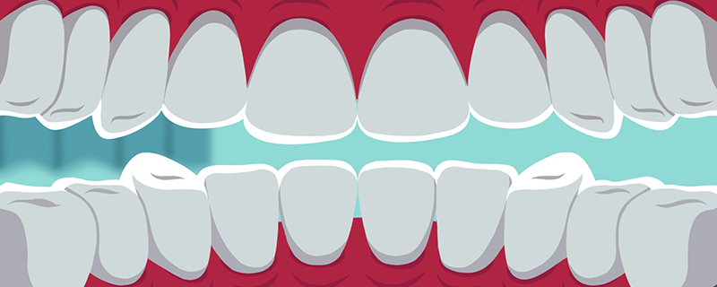 正畸如何預防牙齦萎縮