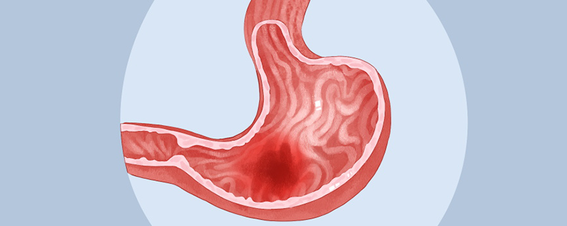 胃出血有哪些癥狀