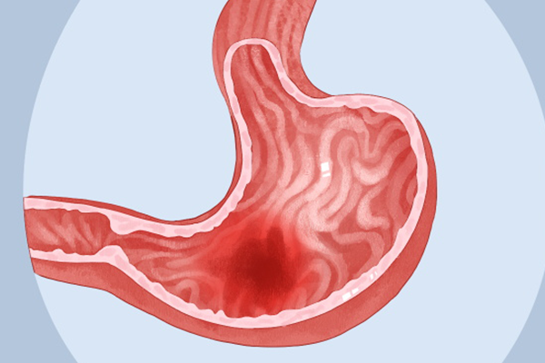  早期胃出血怎么用药
