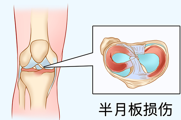 半月板损伤的治疗方法 