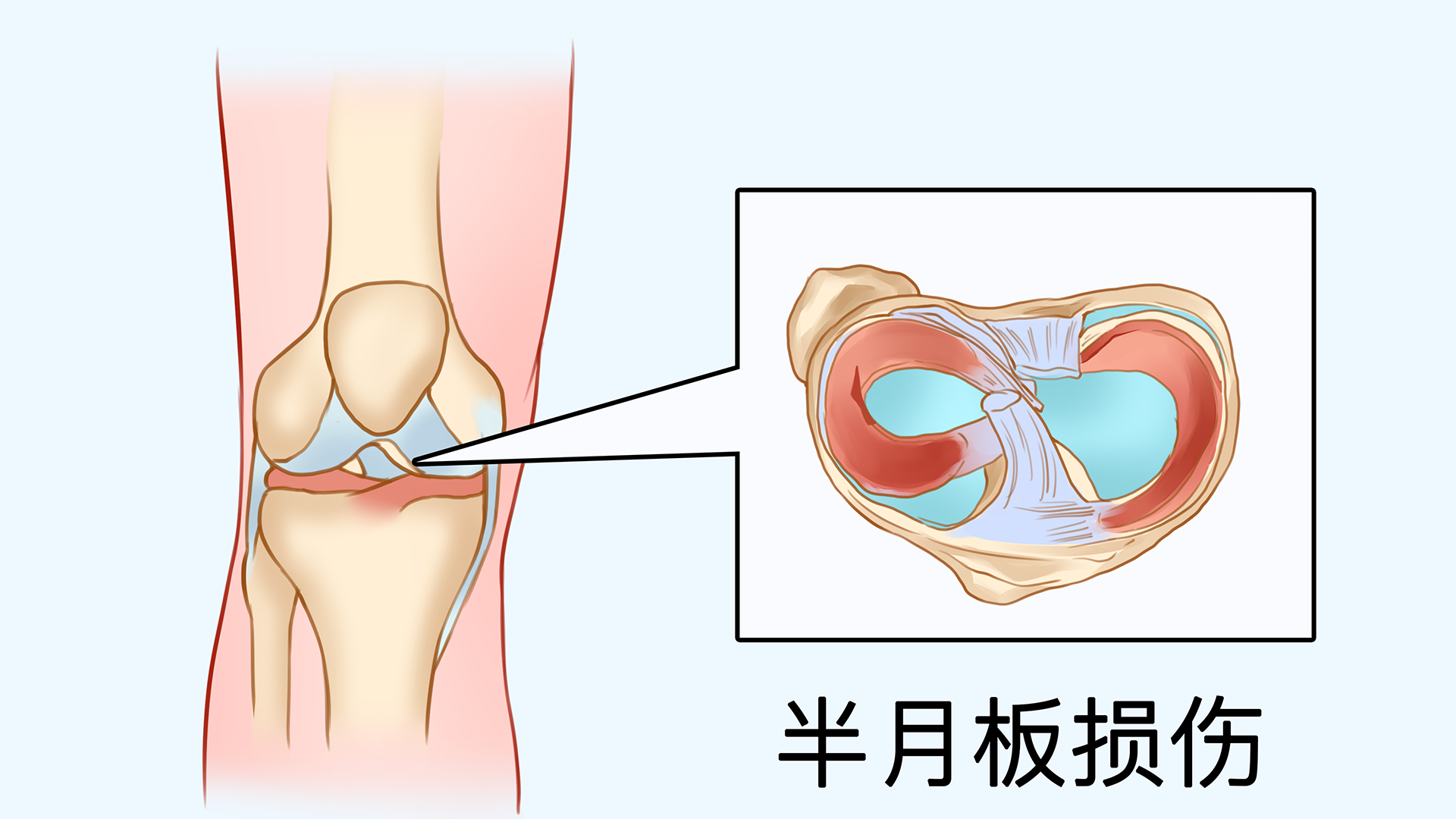 右膝外侧半月板前角损伤怎么回事}