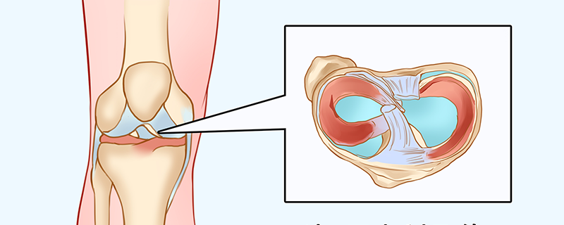 半月板损伤必须腿伸直休养吗}