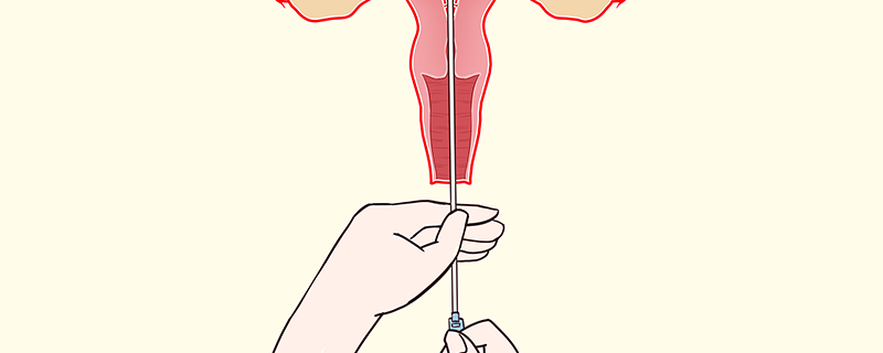 诊刮后干净几天又出血是什么原因