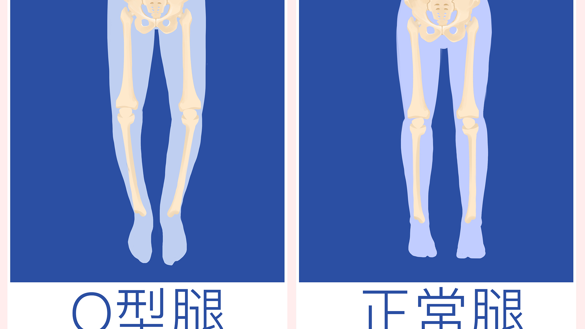 ox型腿怎么矫正