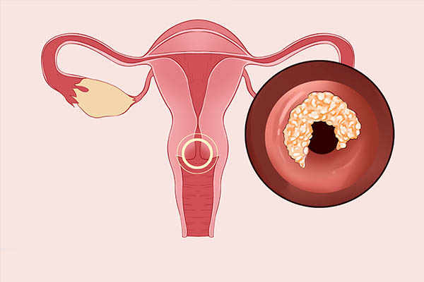 宫颈癌饮食指南