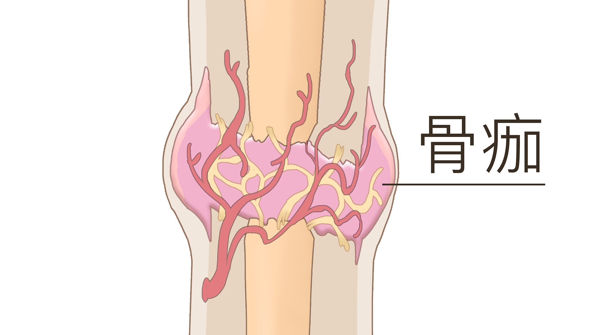 長骨痂時骨折處會疼嗎}