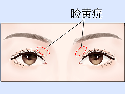 睑黄疣最忌吃什么？这四种食物脸黄疣不要吃