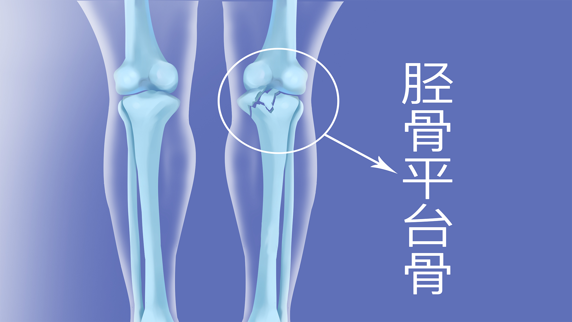 脛腓骨骨折有后遺癥嗎