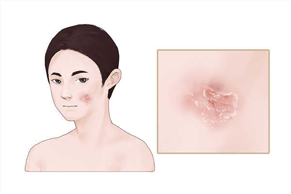 冻疮是由于皮肤哪一部分受损而引起的
