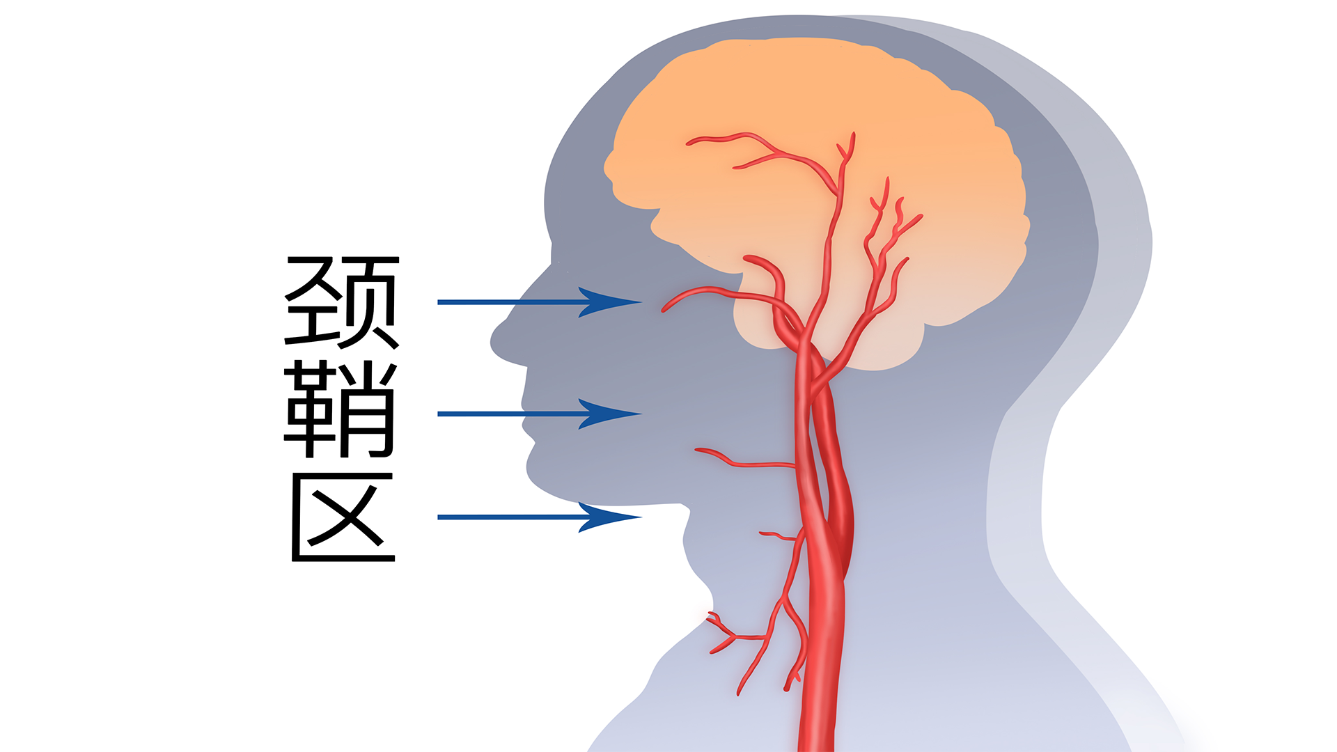 基底节脑梗死怎么回事，怎么办}