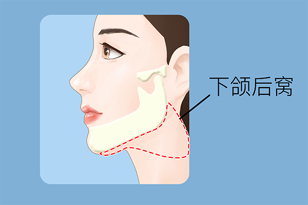 去掉下颌角有什么方法