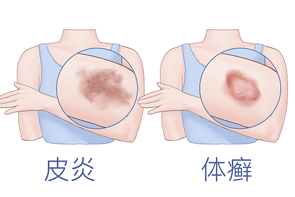 体癣怎么治用什么药膏治疗好