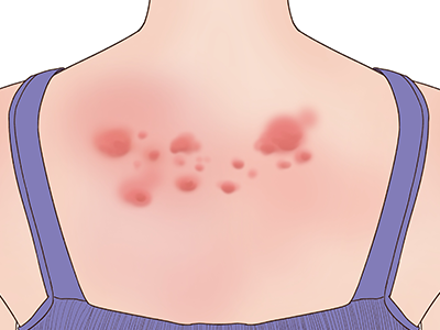 身上起红疙瘩越挠越痒怎么回事