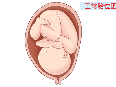 胎位loa是什么意思