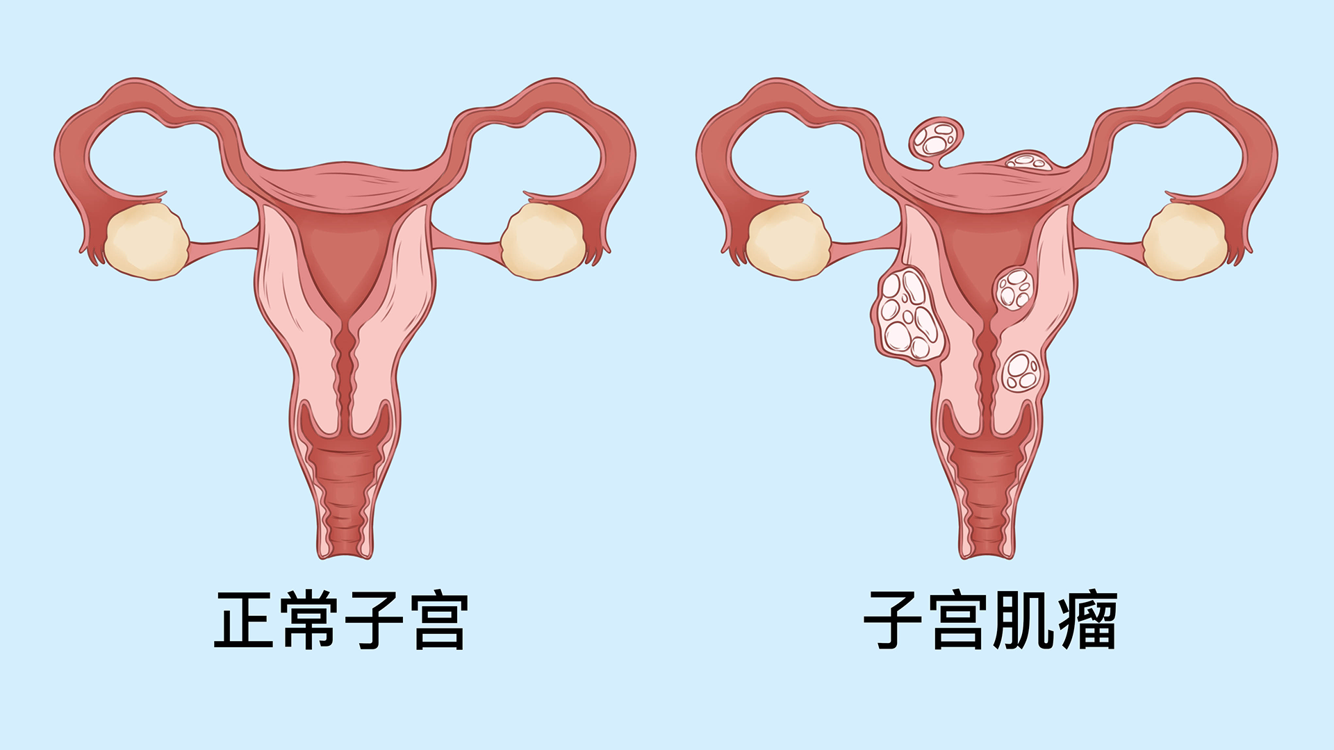 子宮肌瘤切除子宮是大手術(shù)嗎