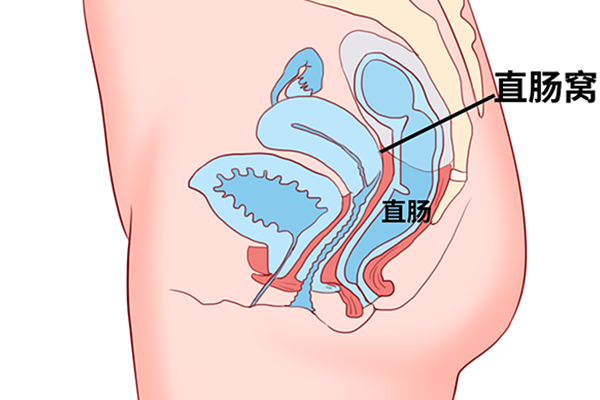 直肠癌可以活多久时间