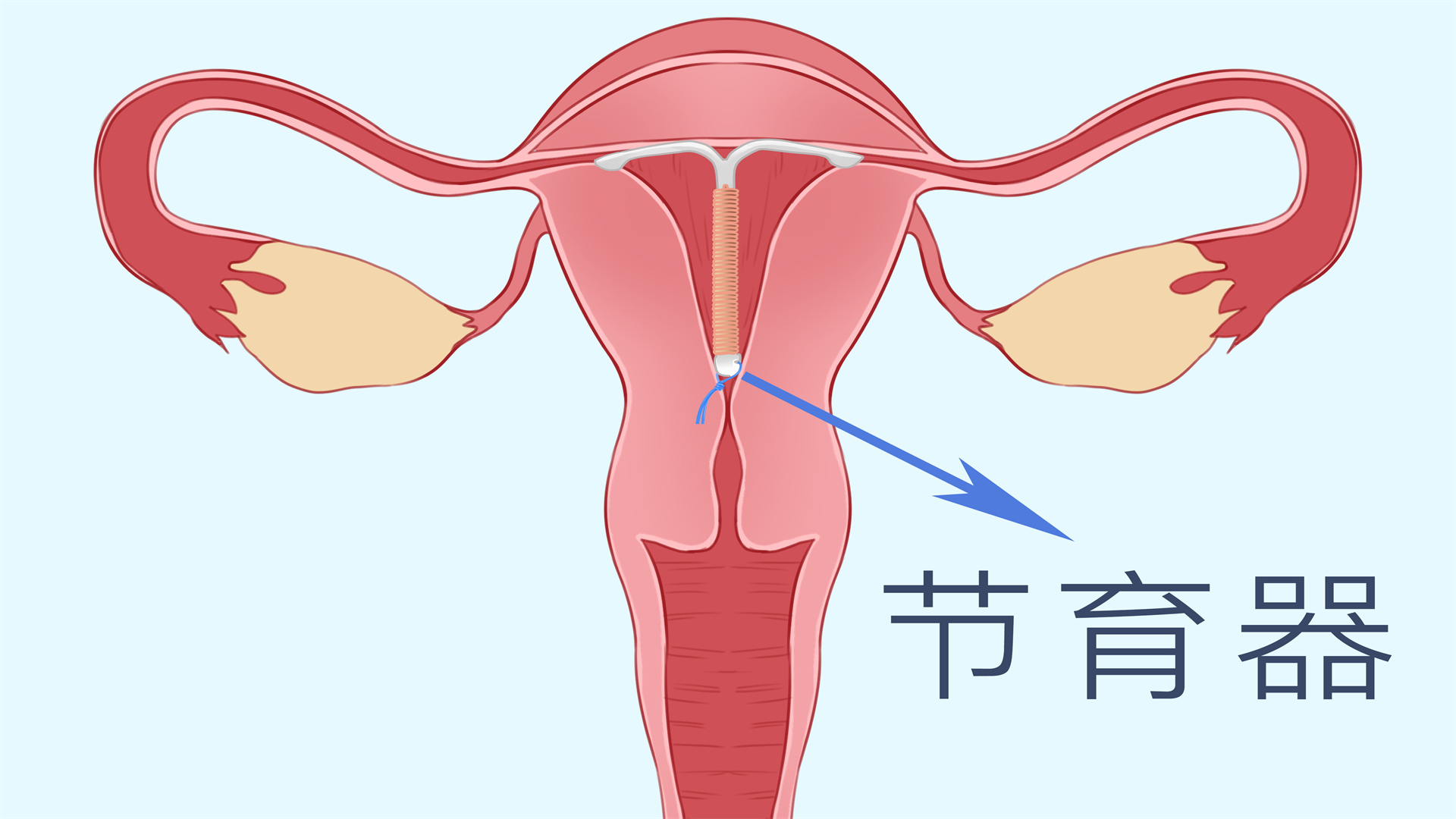 取環(huán)對身體傷害大嗎