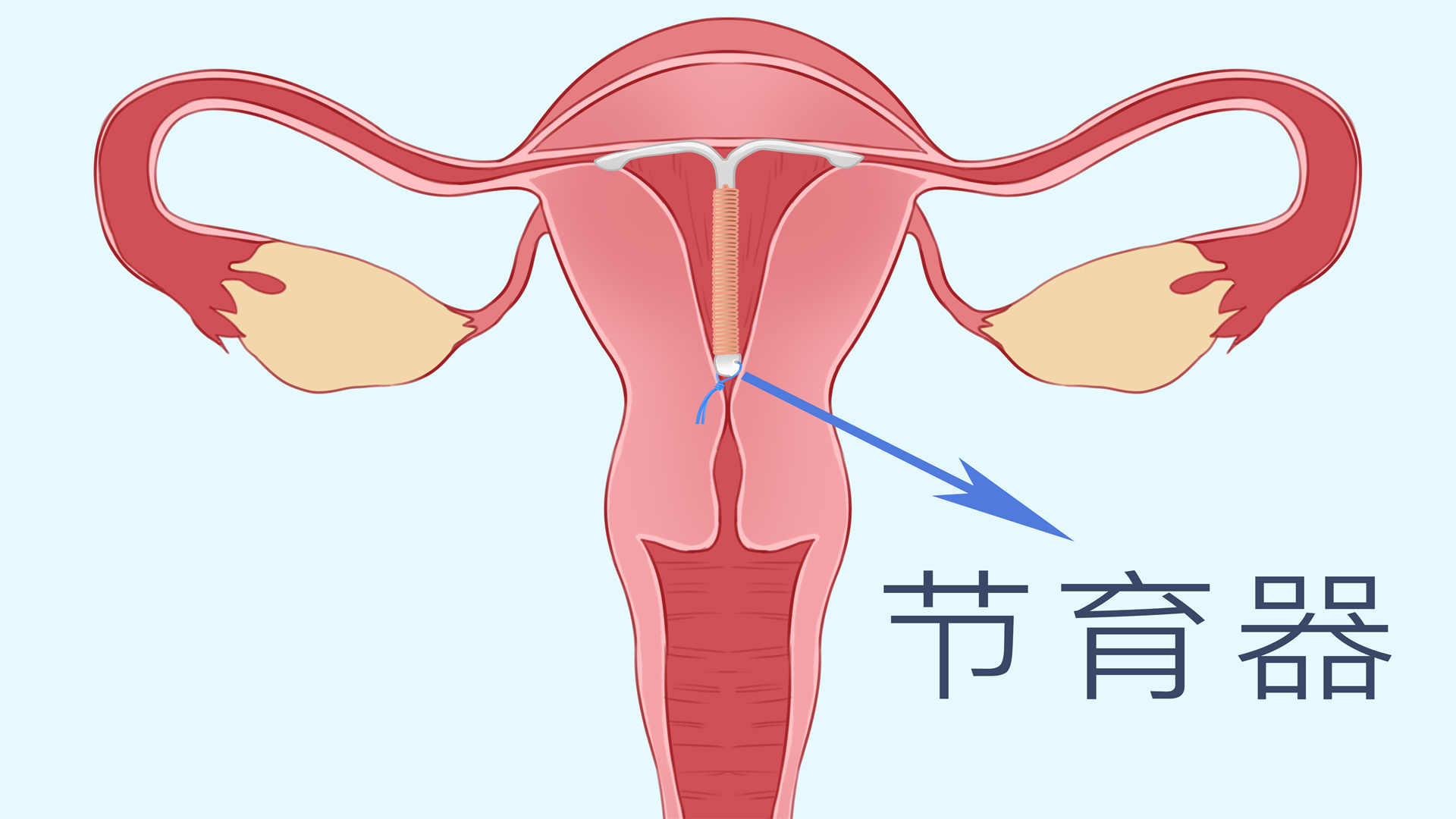 宮內(nèi)環(huán)位置下移怎么辦