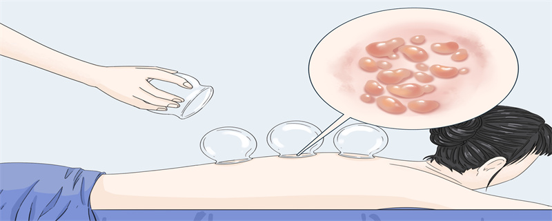 拔罐有水泡是怎么回事