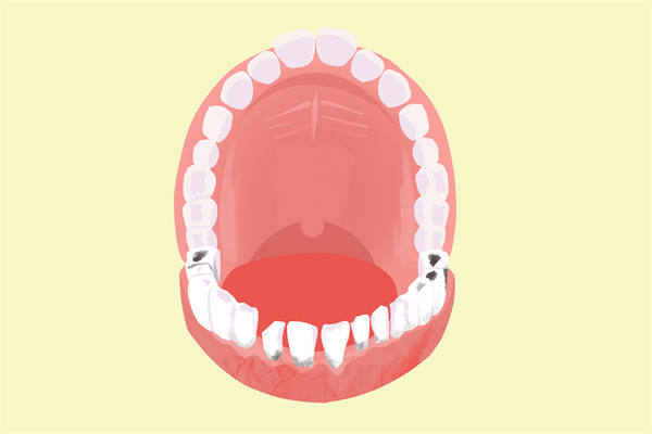 不再疑惑！齲齒形成原因與解決辦法全知道，預(yù)防才是關(guān)鍵！