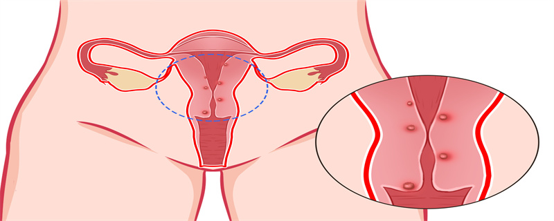 阴道口有花状赘肉是怎么回事}