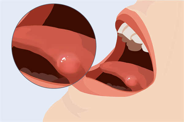 口腔癌早期有什么征兆 
